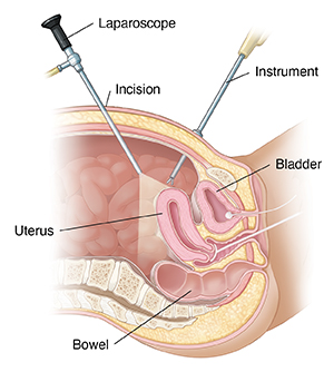 Laparoscopic Hysterectomy ​