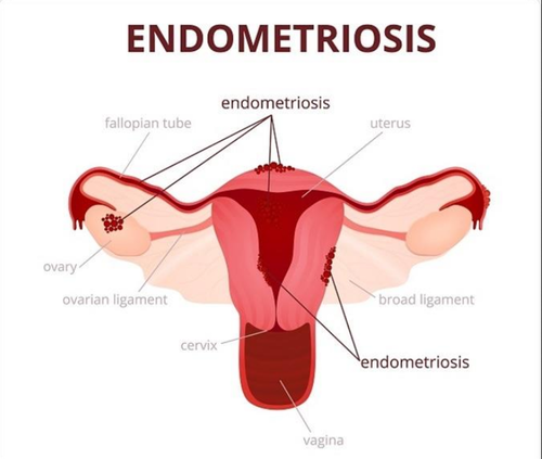 Endometriosis Treatment​