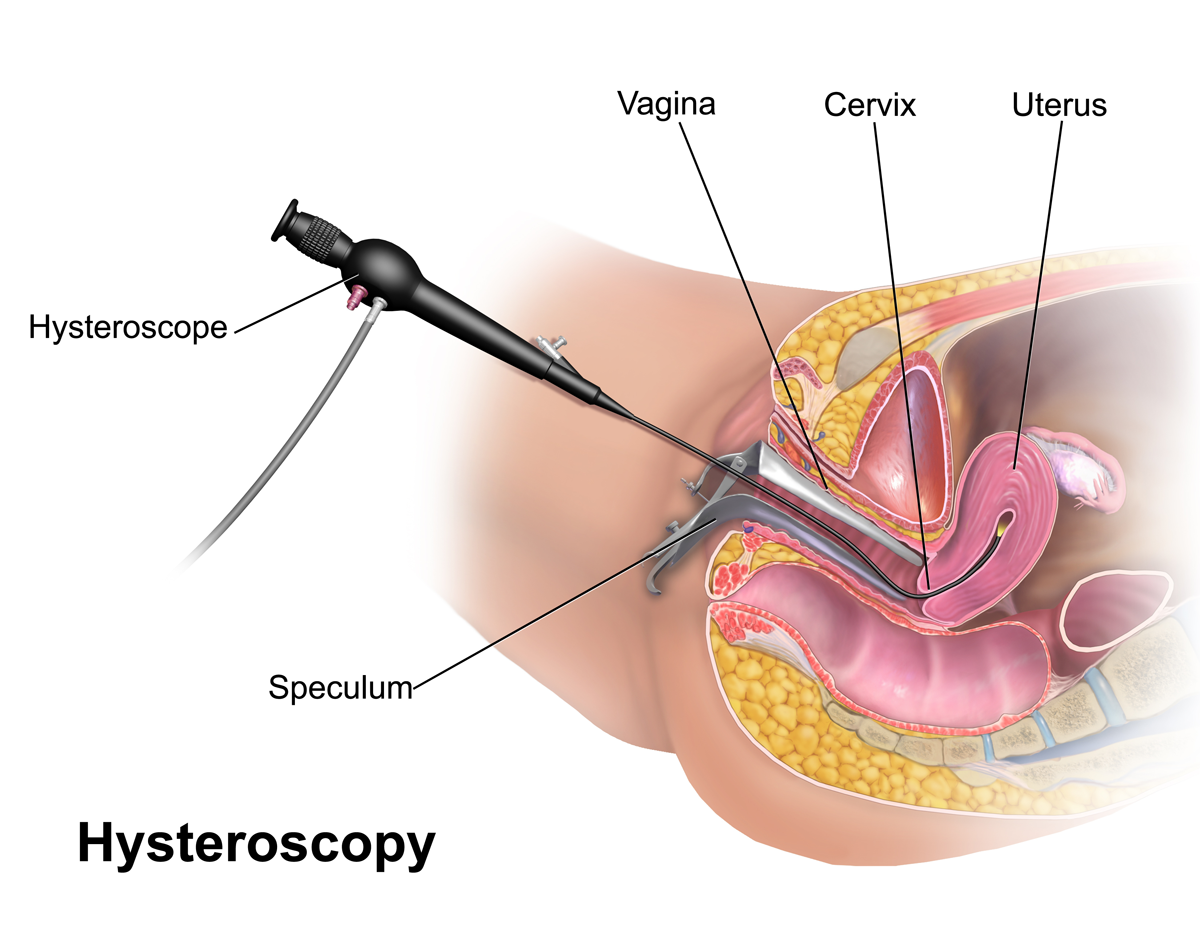 Hysteroscopic