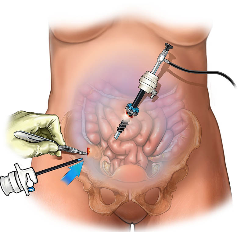 Laparoscopy Ectopic Pregnancy