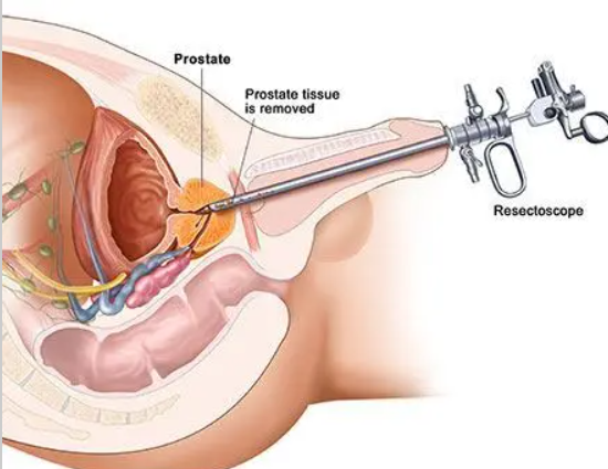 Transurethral Resection