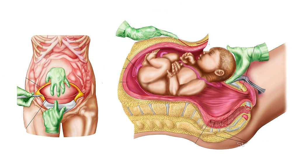 Cesarean Delivery