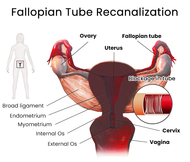 Recanalisation of fallopian tube​