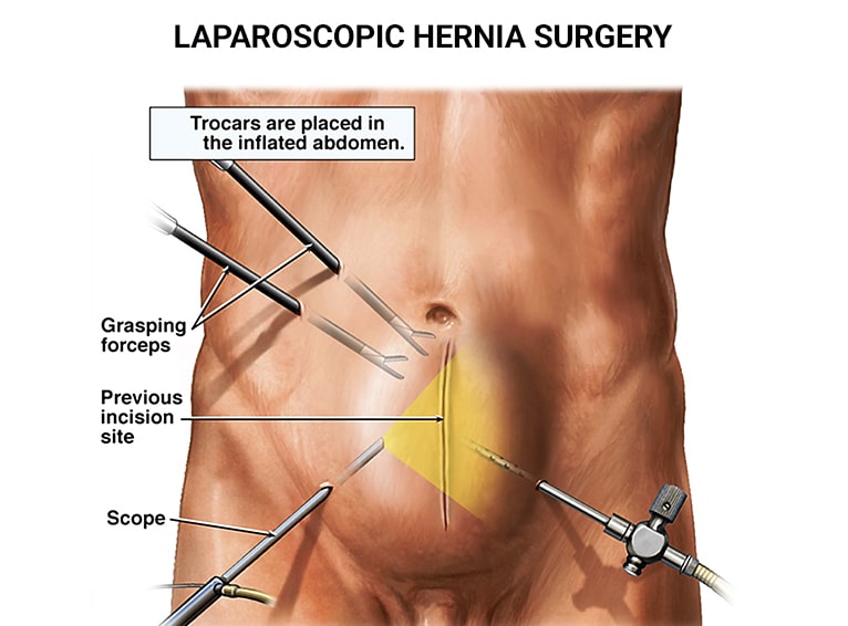 Laparoscopic Hernioplasty​