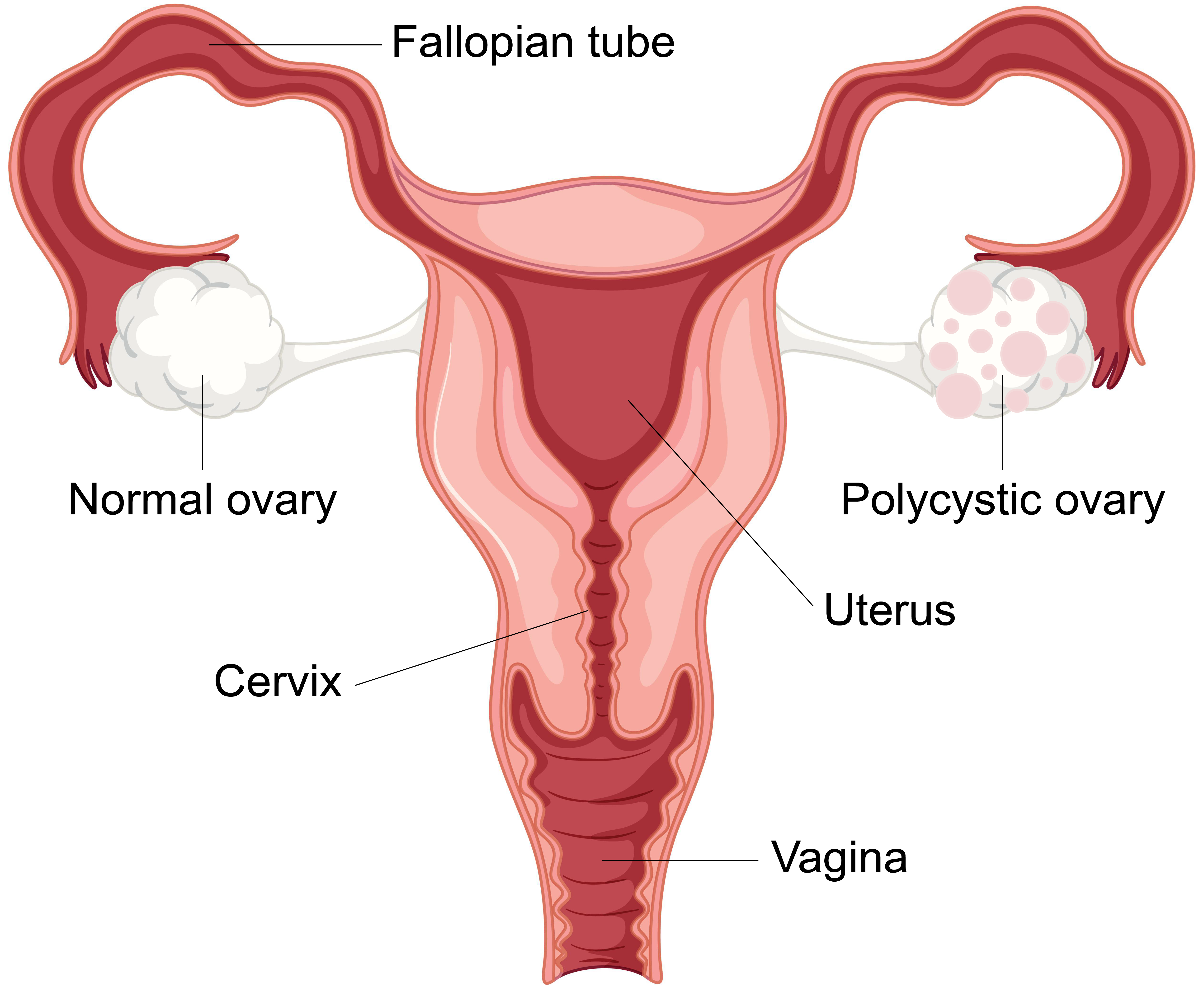 Polycystic Ovarian Disease​